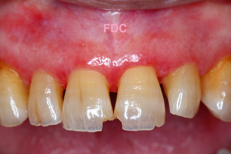 前歯が欠けてしまった時の治療例