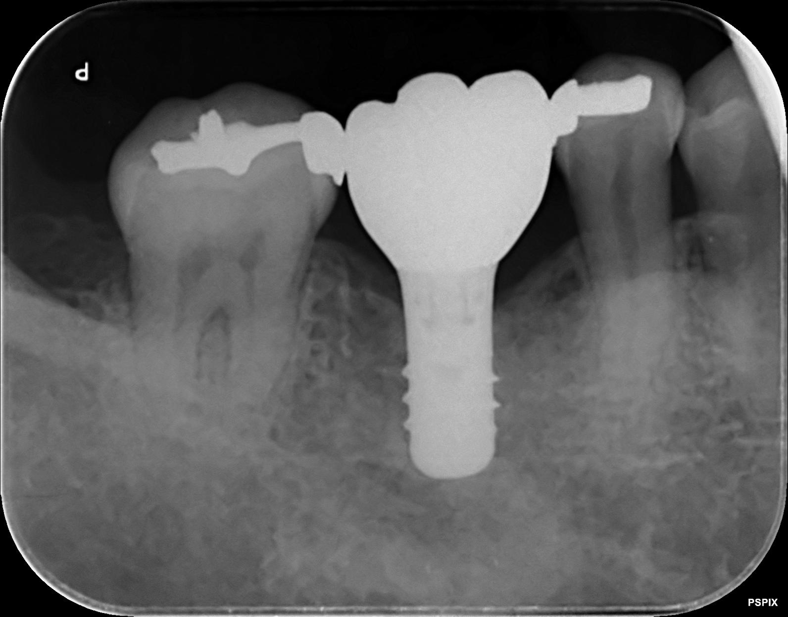歯根破折（歯が割れてしまった状態）に対して抜歯後、インプラントを行った症例