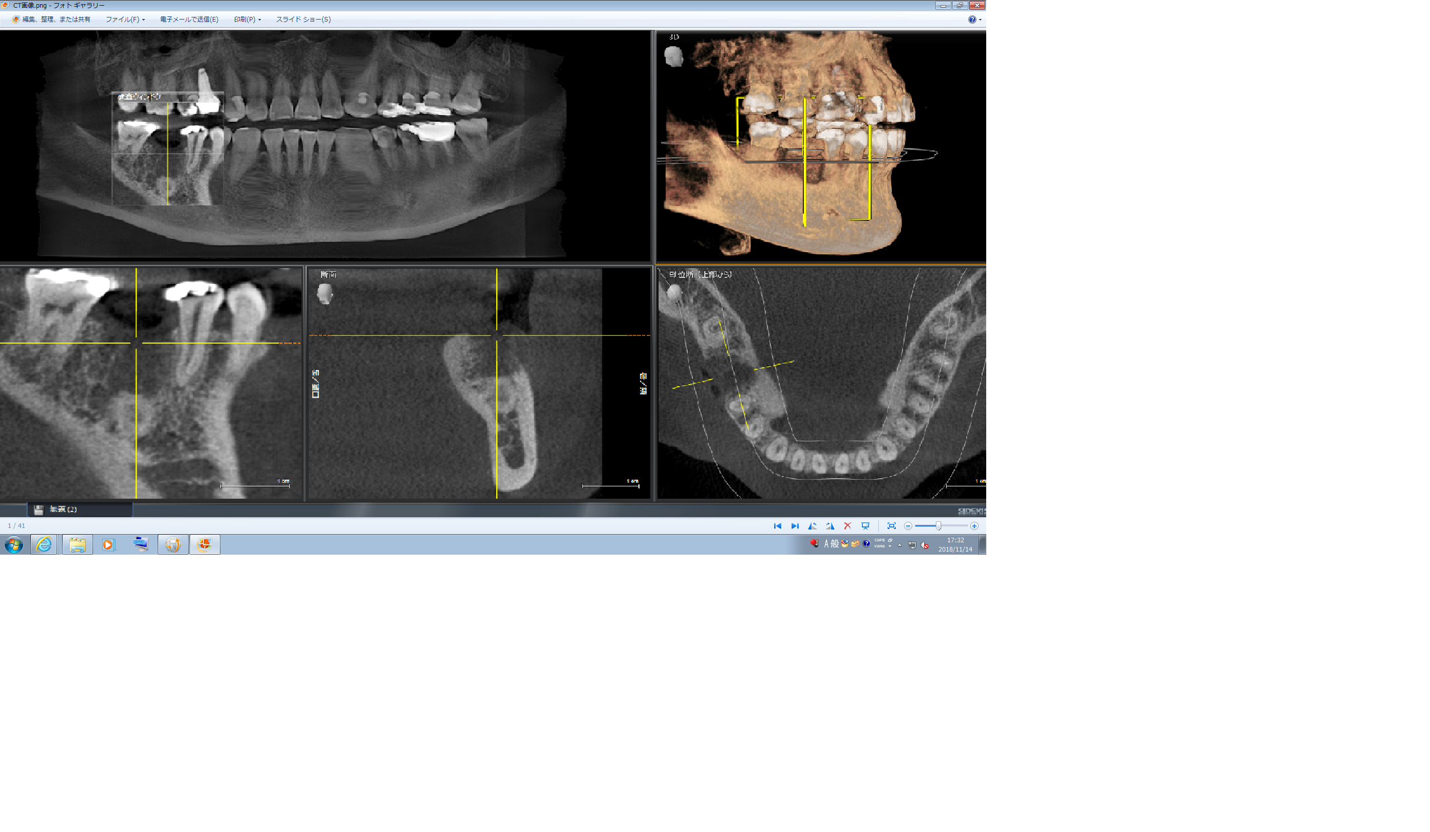 歯根破折（歯が割れてしまった状態）に対して抜歯後、インプラントを行った症例