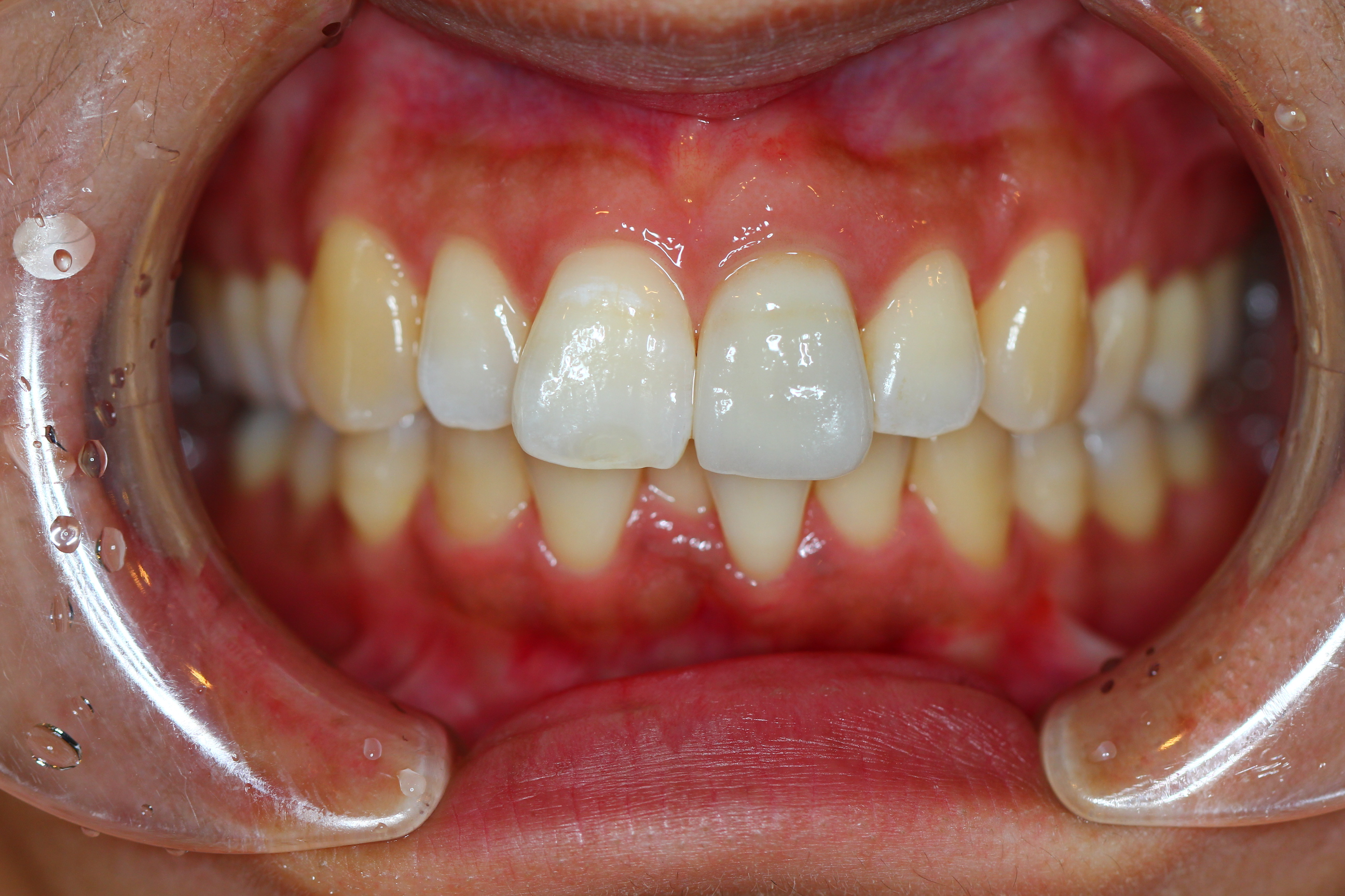 前歯のセラミックス治療
