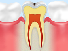 CO：初期の虫歯