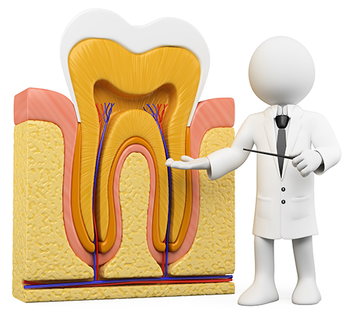 重度の虫歯には根管治療