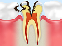 虫歯が神経にまで進行する
