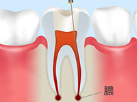 根管内で虫歯が再発する