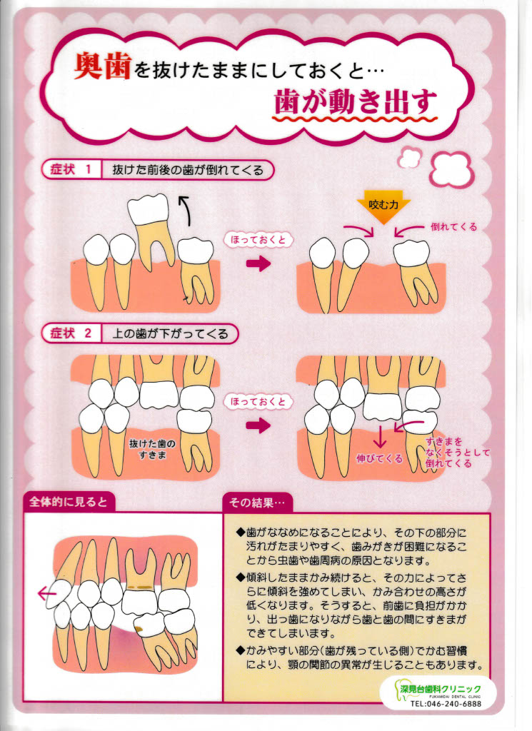 歯 周 病 歯 が 抜け た